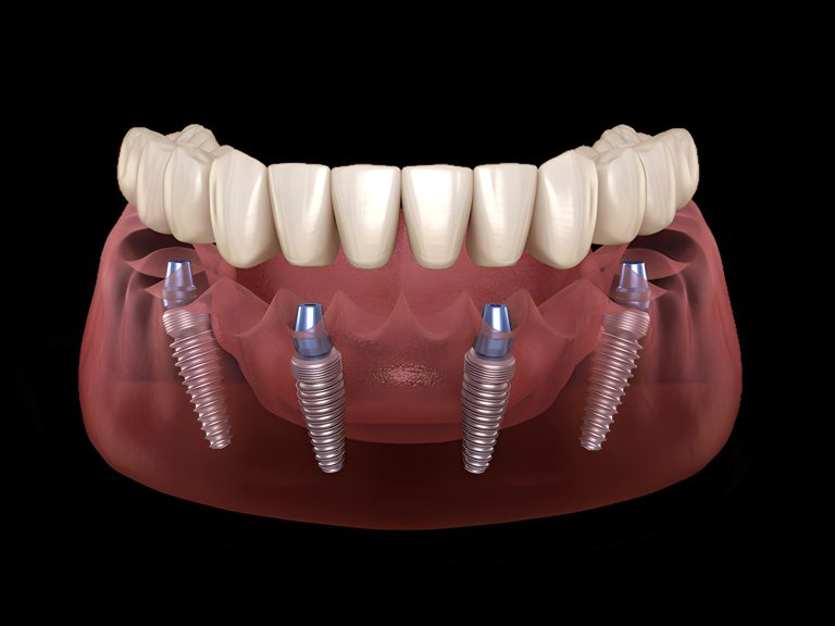 ALL-ON-4® IMPLANT TECHNIQUE - FIXED SOLUTION