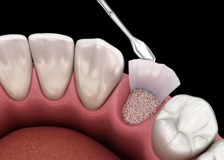 Key Steps in Bone Grafting at Shades Creek Dental