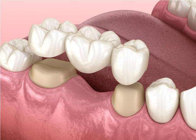 Discover the benefits of dental bridges