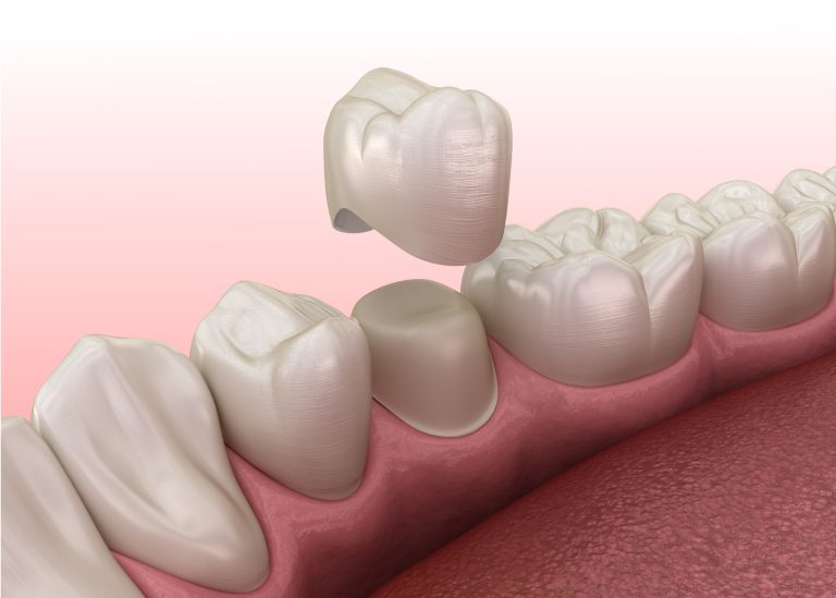 Dental crowns: durable protection, a natural appearance, and a long-lasting solution