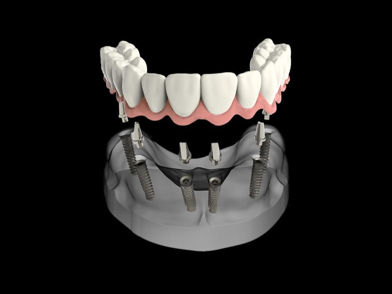 ACRYLIC OVERDENTURE