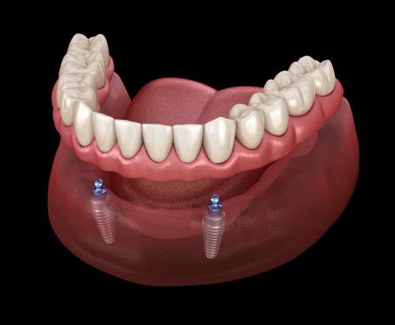 FIXED TEETH VS. REMOVABLE OPTIONS