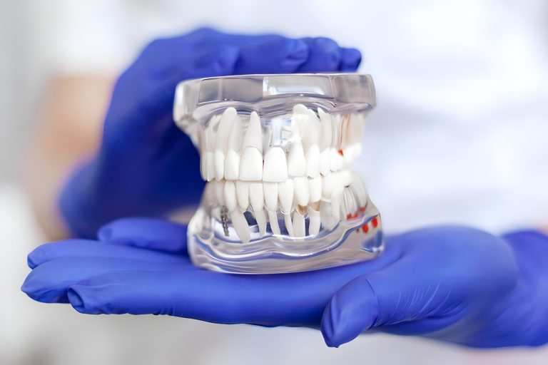 TEETH-IN-A-DAY