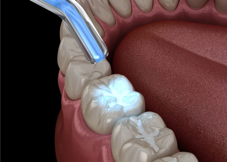 Experience the benefits of professional teeth whitening
