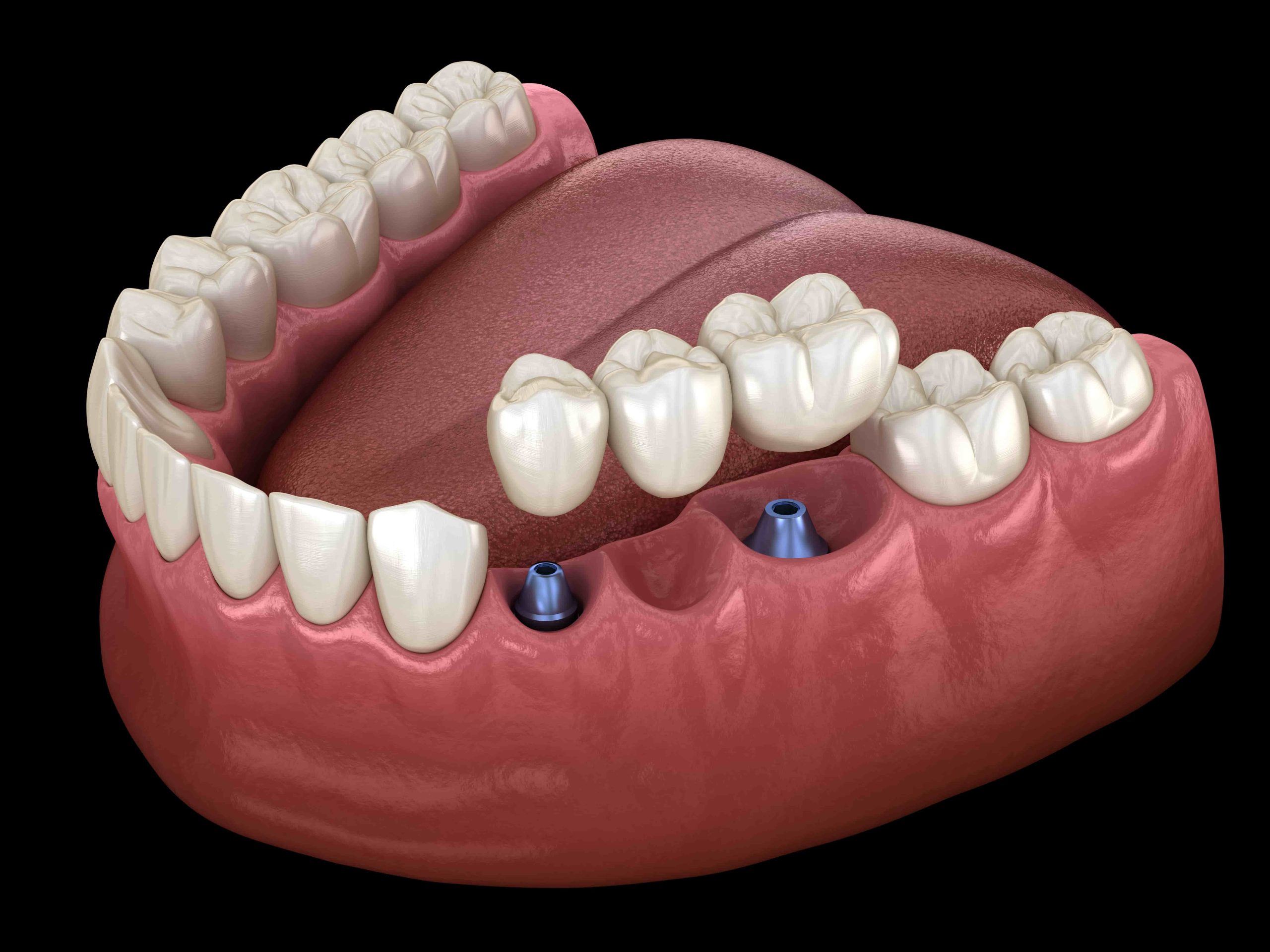 EVALUATING YOUR TOOTH REPLACEMENT CHOICES